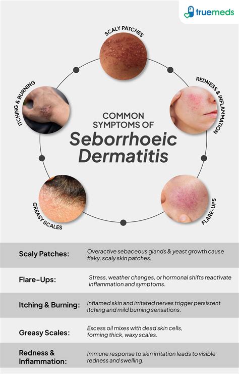 infographic of seborrheic dermatitis symptoms