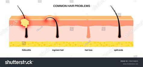 ingrown hair vs folliculitis infographic