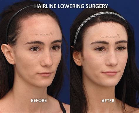 forehead reduction hairline surgical planning