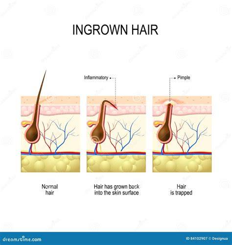 diagram of ingrown hair formation and surgical removal