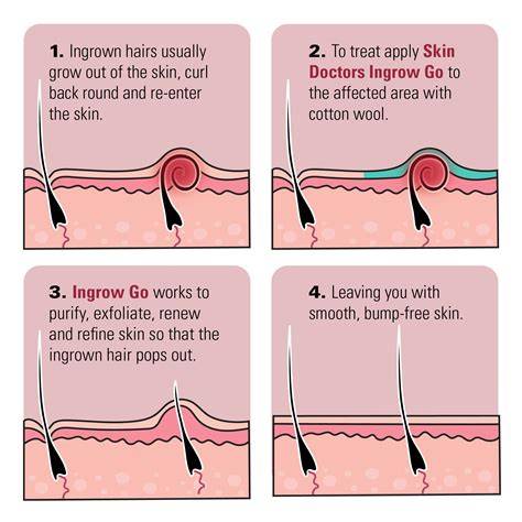 conceptual map of ingrown hair treatment options