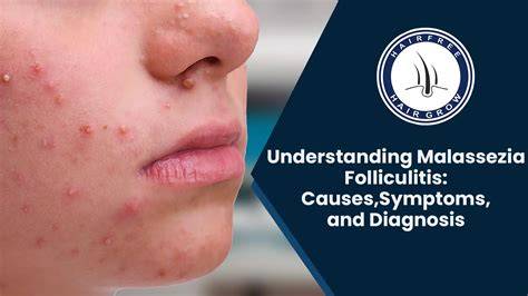 Infographic of Malassezia Folliculitis Distribution