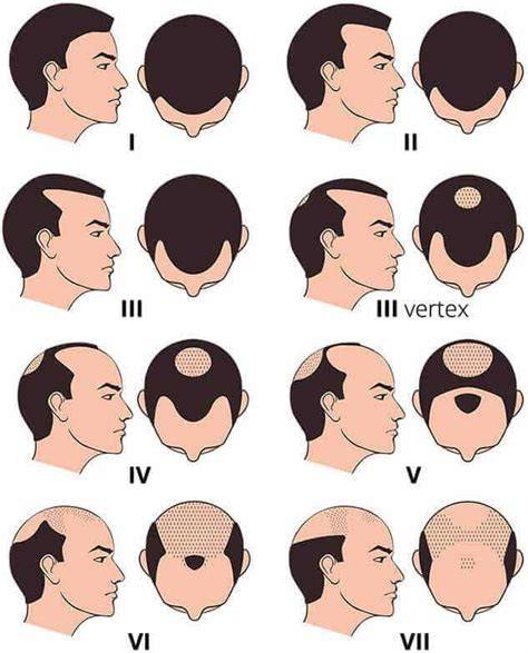 schematic vertex hair loss pattern
