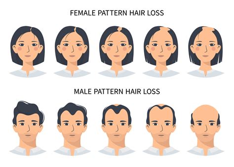 infographic showing male vs female receding hairline patterns