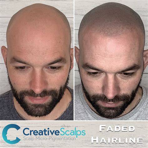 Scalp micropigmentation before and after results