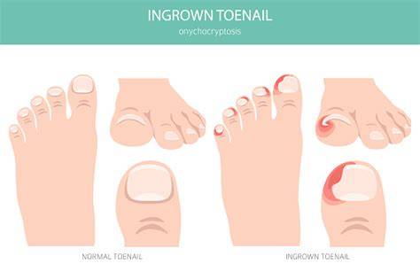 infographic of ingrown toenail progression