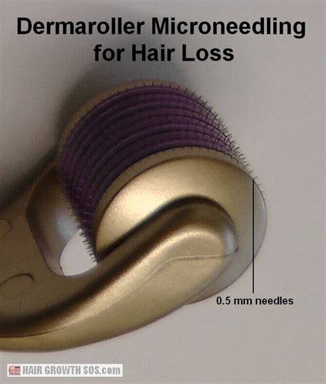 dermaroller needles for scalp hair growth