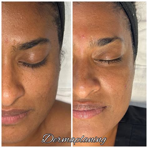before-after-dermaplaning-glow-guide