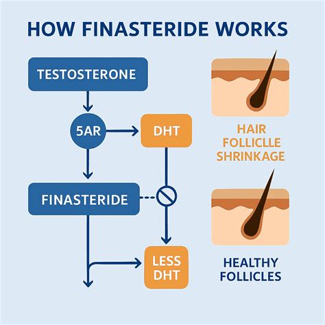 Oral finasteride and antiandrogens overview