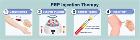 PRP injection procedure around median nerve