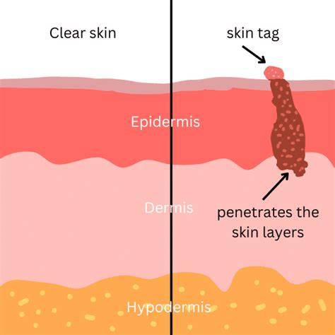 illustrative diagram of skin tag anatomy and common locations
