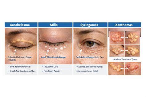 Eye conditions infographic illustrating stye, chalazion, milia, and xanthelasma