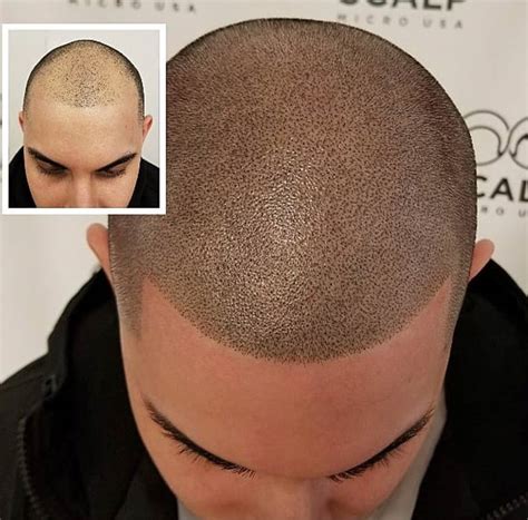 scalp micropigmentation process close-up